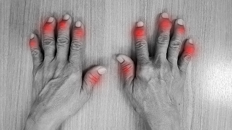 osteoarthritida 2 -